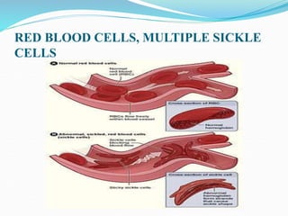 RED BLOOD CELLS, MULTIPLE SICKLE
CELLS
 