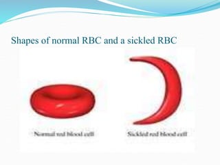 Shapes of normal RBC and a sickled RBC
 