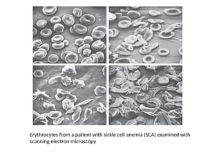sickle cell anemia importance of transfusion therapy | PPTX