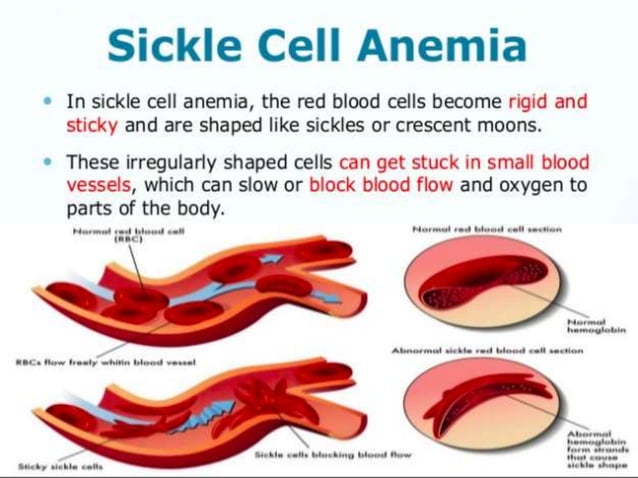 Sickle cell anemia and thalassemia | PPTX