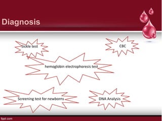 Diagnosis
Sickle test
hemoglobin electrophoresis test
Screening test for newborns DNA Analysis
CBC
 