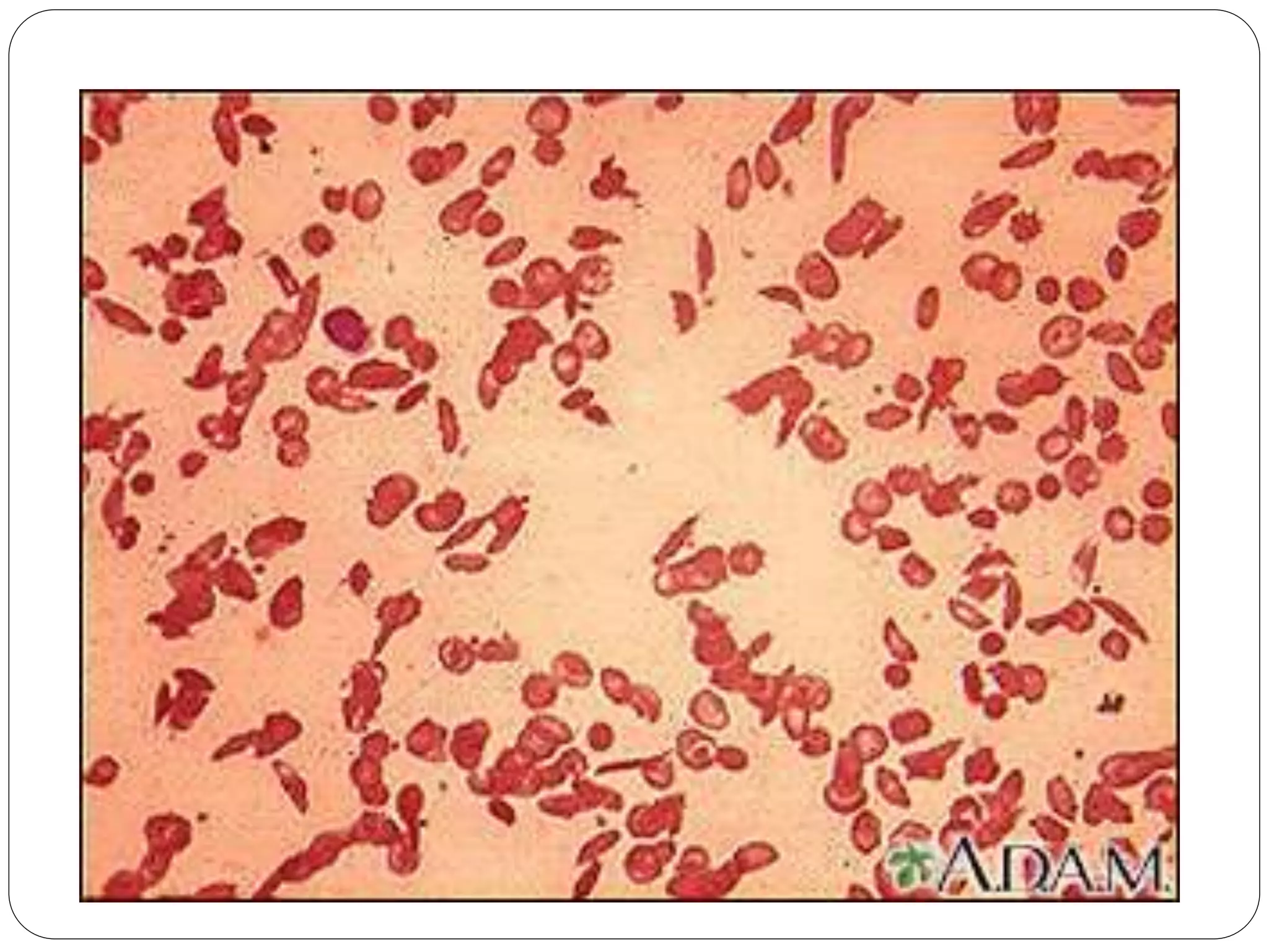 Sickle Cell Disease PPT sickle-cell-disease-ppt