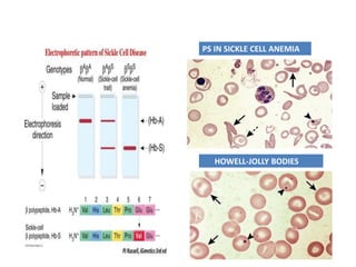 HOWELL-JOLLY BODIES
PS IN SICKLE CELL ANEMIA
 