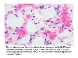 The peripheral smear from this patient shows numerous sickled RBC's and
the absence of polychromasia. A high power view of the biopsy illustrates
the sinus plugging with sickled RBCs. A single nucleated erythroid precursor
is present (arrow).
 