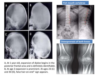 A, At 1 year old, expansion of diploe begins in the
posterior frontal area and is definitely identifiable.
B, At age 2 expansion is prominent. At ages 23 (C)
and 30 (D), false hair-on-end” sign appears.
Fish mouth vertebrae
Osteoprorosis of both knees
 