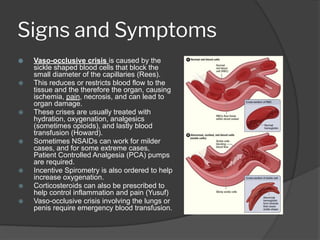 Sickle Cell Disease Presentation and its symptoms | PDF