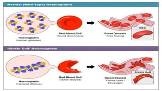 Comprehensive Overview of Sickle Cell Disease: Genetics, Symptoms, and ...