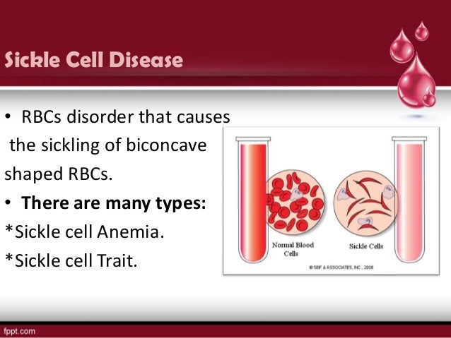 the features of the sicle cell disease and its treatment the features of the sicle cell disease and its treatment