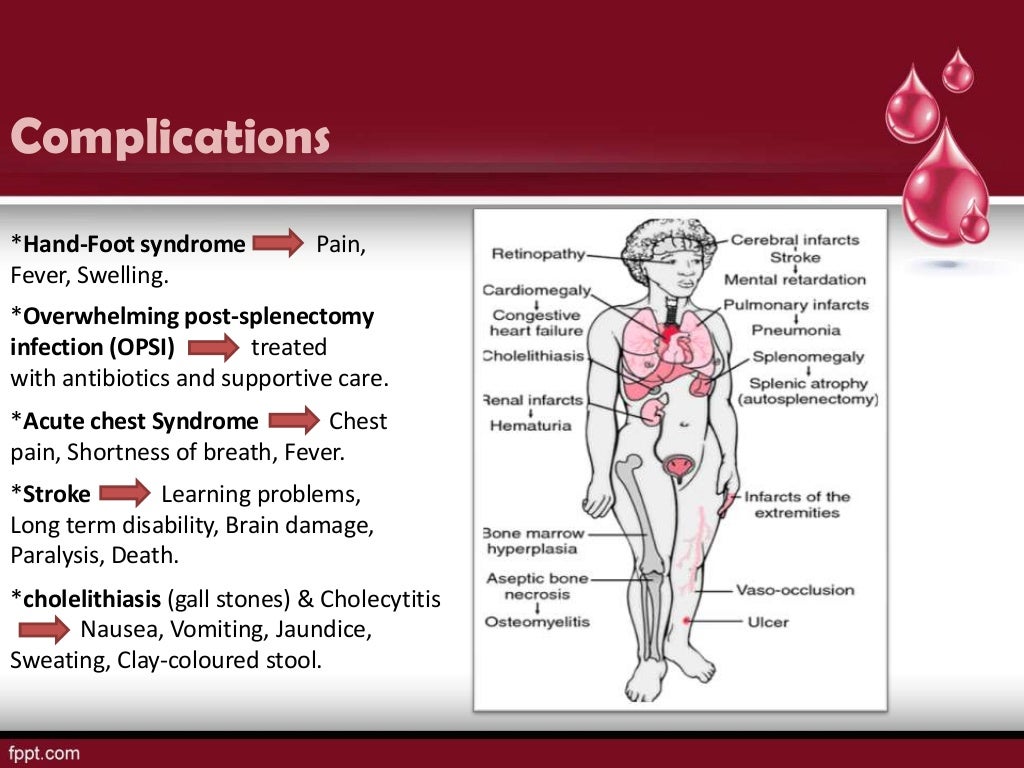 Sickle Cell Disease