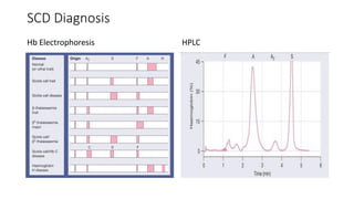 Scd Electropherogram Topic: SICKLE CELL DISEASE IN CHILDREN-3.pdf