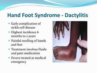 Hand Foot Syndrome - Dactylitis
 Early complication of
sickle cell disease
 Highest incidence 6
months to 2 years
 Painful swelling of hands
and feet
 Treatment involves fluids
and pain medication
 Fevers treated as medical
emergency
 