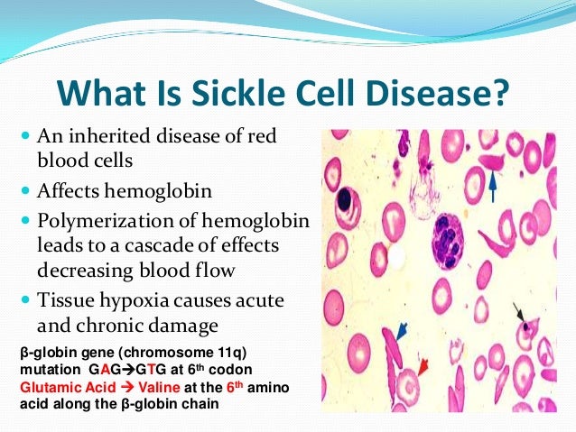 the signs symptoms and treatment of sickle cell disease Signs of sickle cell disease usually begin in early childhood the severity of symptoms can vary from person to person sickle-cell disease may lead to various acute. the signs symptoms and treatment of sickle cell disease Signs of sickle cell disease usually begin in early childhood the severity of symptoms can vary from person to person sickle-cell disease may lead to various acute.