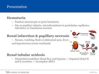 S L I D E 13
Presentation
Hematuria
– Painless microscopic or gross hematuria
– Due to papillary infarcts, microthrombosis in peritubular capillaries,
infections, or transfusion reaction
Renal infarction & papillary necrosis
– Nausea, vomiting, flank or abdominal pain, fever,
and hypertension (renin-mediated)
Renal tubular acidosis
– Diminished medullary blood flow and hypoxia -> Impaired distal H
and K secretion -> incomplete dRTA
 