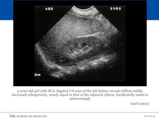S L I D E 25
3-year-old girl with SCA. Sagittal US scan of the left kidney reveals diffuse mildly
increased echogenicity, nearly equal to that of the adjacent spleen. Incidentally noted is
splenomegaly
Gael (2001)
 