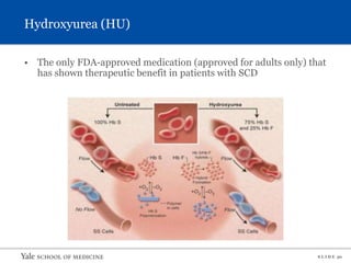 S L I D E 30
Hydroxyurea (HU)
• The only FDA-approved medication (approved for adults only) that
has shown therapeutic benefit in patients with SCD
 