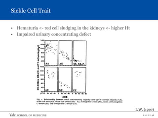 S L I D E 38
Sickle Cell Trait
• Hematuria <- red cell sludging in the kidneys <- higher Ht
• Impaired urinary concentrating defect
L.W. (1970)
 