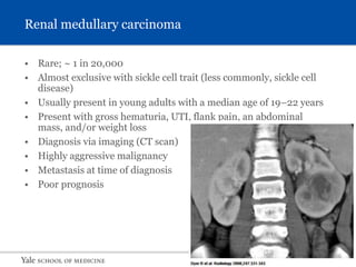S L I D E 42
Renal medullary carcinoma
• Rare; ~ 1 in 20,000
• Almost exclusive with sickle cell trait (less commonly, sickle cell
disease)
• Usually present in young adults with a median age of 19–22 years
• Present with gross hematuria, UTI, flank pain, an abdominal
mass, and/or weight loss
• Diagnosis via imaging (CT scan)
• Highly aggressive malignancy
• Metastasis at time of diagnosis
• Poor prognosis
 