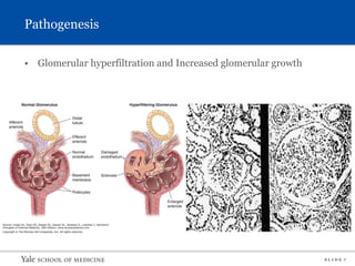 S L I D E 7
Pathogenesis
• Glomerular hyperfiltration and Increased glomerular growth
 