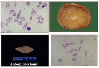 Autosplenectomy
 