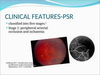 treatment of SICKLE CELL RETINOPATHY.NYOD.ppt