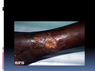 incidence
 The incidence of leg ulcers in patients with
SCD ranges from 25.7% to 75%.
 