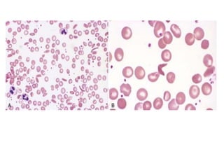 Comprehensive Overview of Sickle Cell Disease and Immune Hemolytic ...