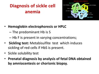 Comprehensive Overview of Sickle Cell Disease and Immune Hemolytic ...