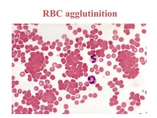Comprehensive Overview of Sickle Cell Disease and Immune Hemolytic ...