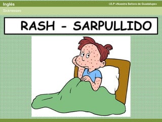 I.E.P «Nuestra Señora de Guadalupe»Inglés
Sicknesses
RASH - SARPULLIDO