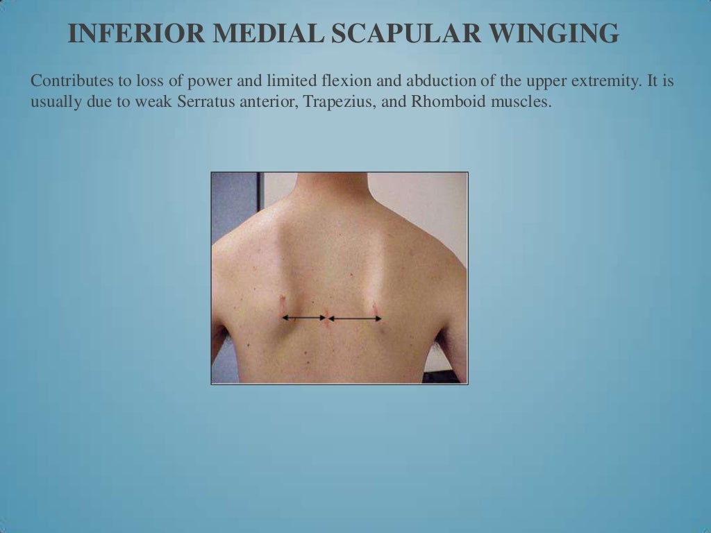 Scapula fracture treatment picture