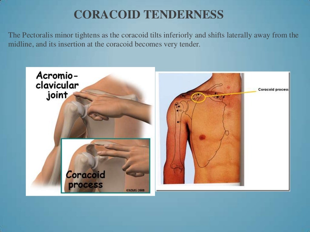 Scapula fracture in elderly picture