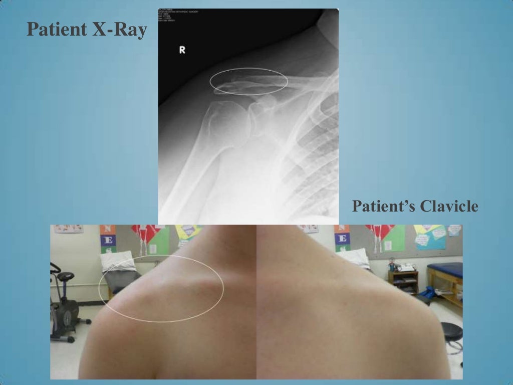 How to sleep with a broken scapula image