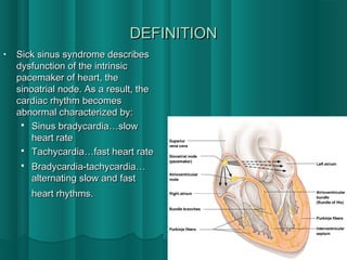 Sick sinus syndrome-2 | PPT