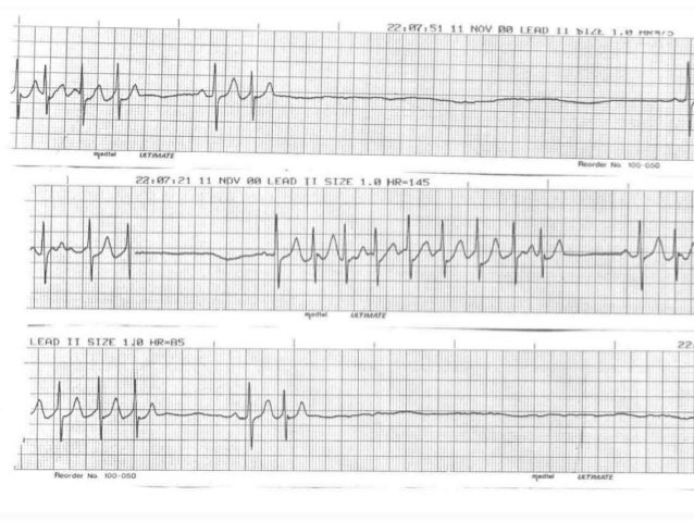 sick sinus syndrome and pacemaker sick sinus syndrome and pacemaker
