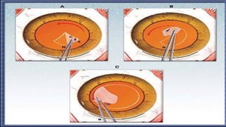Small Incsion Small incision cataract surgery in Modern era | PPTX