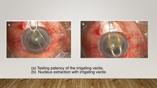 (a) Testing patency of the irrigating vectis.
(b) Nucleus extraction with irrigating vectis
 