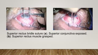 Superior rectus bridle suture (a). Superior conjunctiva exposed.
(b). Superior rectus muscle grasped.
 