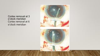 Cortex removal at 3
o’clock meridian
Cortex removal at 6
o’clock meridian
 