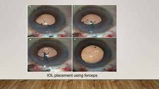 IOL placement using forceps
 