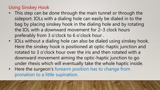 Using Sinskey Hook
• This step can be done through the main tunnel or through the
sideport. IOLs with a dialing hole can easily be dialed in to the
bag by placing sinskey hook in the dialing hole and by rotating
the IOL with a downward movement for 2–3 clock hours
preferably from 3 o’clock to 6 o’clock hour .
• IOLs without a dialing hole can also be dialed using sinskey hook.
Here the sinskey hook is positioned at optic-haptic junction and
rotated to 3 o’clock hour over the iris and then rotated with a
downward movement aiming the optic-haptic junction to go
under rhexis which will eventually take the whole haptic inside.
• Here the surgeon’s forearm position has to change from
pronation to a little supination.
 