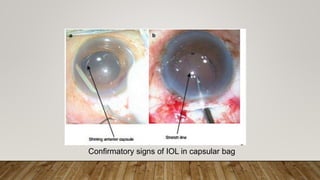 Confirmatory signs of IOL in capsular bag
 