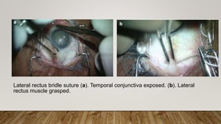 Lateral rectus bridle suture (a). Temporal conjunctiva exposed. (b). Lateral
rectus muscle grasped.
 