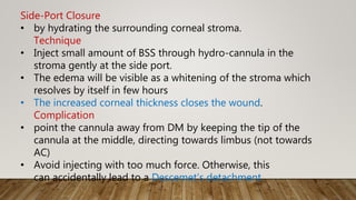 Side-Port Closure
• by hydrating the surrounding corneal stroma.
Technique
• Inject small amount of BSS through hydro-cannula in the
stroma gently at the side port.
• The edema will be visible as a whitening of the stroma which
resolves by itself in few hours
• The increased corneal thickness closes the wound.
Complication
• point the cannula away from DM by keeping the tip of the
cannula at the middle, directing towards limbus (not towards
AC)
• Avoid injecting with too much force. Otherwise, this
can accidentally lead to a Descemet’s detachment.
 