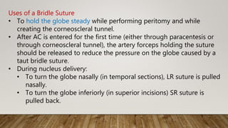 Uses of a Bridle Suture
• To hold the globe steady while performing peritomy and while
creating the corneoscleral tunnel.
• After AC is entered for the first time (either through paracentesis or
through corneoscleral tunnel), the artery forceps holding the suture
should be released to reduce the pressure on the globe caused by a
taut bridle suture.
• During nucleus delivery:
• To turn the globe nasally (in temporal sections), LR suture is pulled
nasally.
• To turn the globe inferiorly (in superior incisions) SR suture is
pulled back.
 