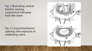 Fig. 2 Illustrating vertical
traction causing
conjunctival fold away
from the sclera
Fig. 3 Conjunctival/tenon
opening with exposure of
underlying sclera
 