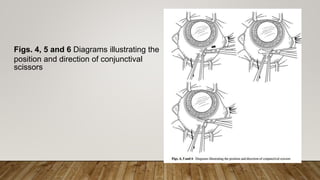 Figs. 4, 5 and 6 Diagrams illustrating the
position and direction of conjunctival
scissors
 