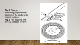 Fig. 8 Diagram
illustrating perpendicular
position of the blade while
making incision
Fig. 9 Non-sagging and
closely apposed incision
 