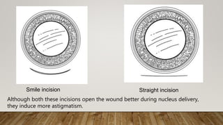 Straight incision
Although both these incisions open the wound better during nucleus delivery,
they induce more astigmatism.
Smile incision
 