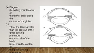 (a) Diagram
illustrating maintenance
of
the tunnel blade along
the
contour of the globe.
(b)
Tilt of the blade greater
than the contour of the
globe causing
premature
entry and tilt of the
blade
lesser than the contour
of
the globe causing
 