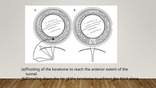 (a)Pivoting of the keratome to reach the anterior extent of the
tunnel.
(b)Dimpling down the tip of the keratome to achieve the third plane
 